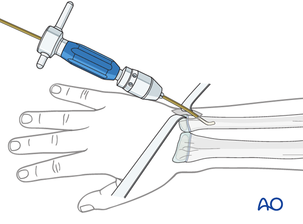 Nail insertion