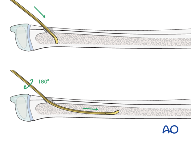 Nail insertion