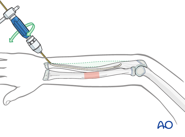 Advancing the nail