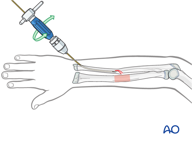 Advancing the nail