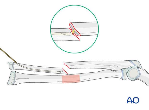 Reduction with nail