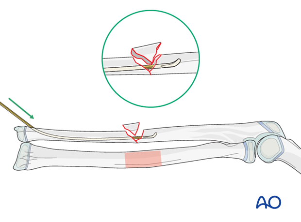 Reduction with nail