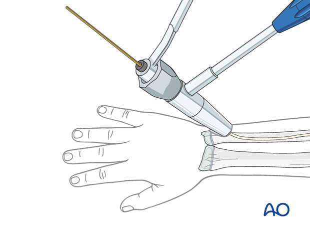 Cutting the nail