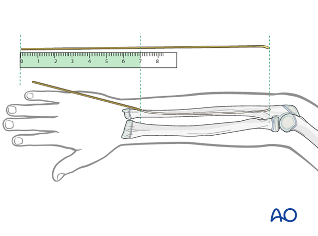 Estimate the optimum nail length with a second identical nail placed parallel to the initial nail.