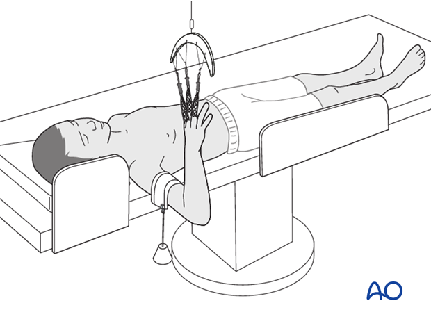 Supine position for casting