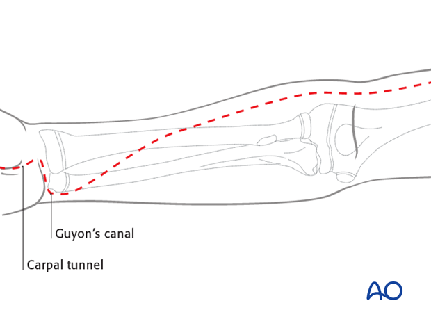 compartment syndrome