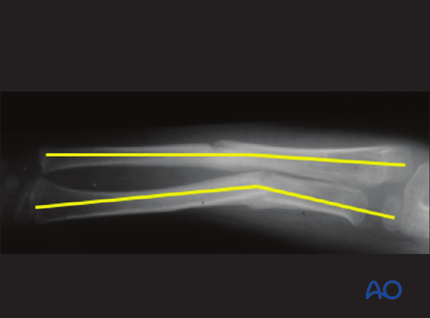 fracture instability and malalignment