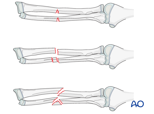 fracture instability and malalignment