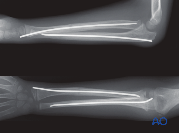 fracture instability and malalignment