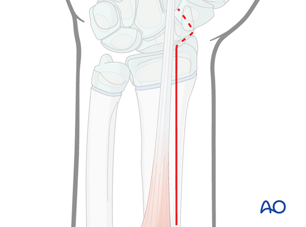 open reduction k wire fixation