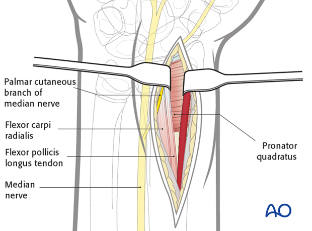 volar anterior approach to the distal radius