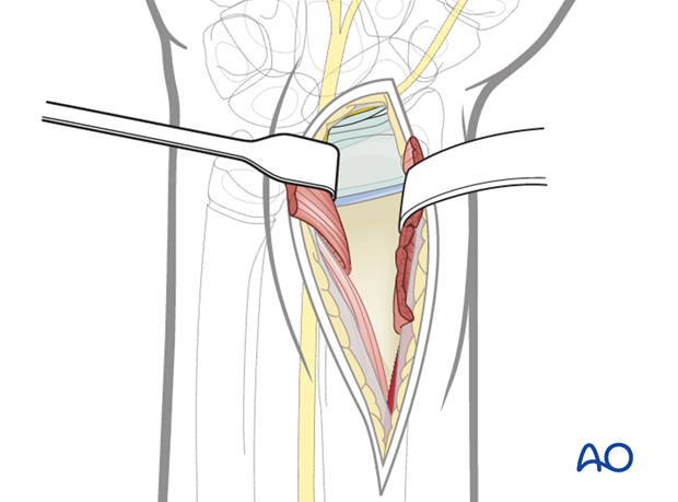 volar anterior approach to the distal radius