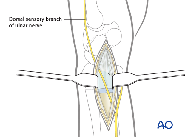 ulnar approach to the distal ulna