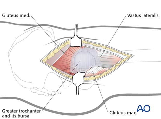 transgluteal approach