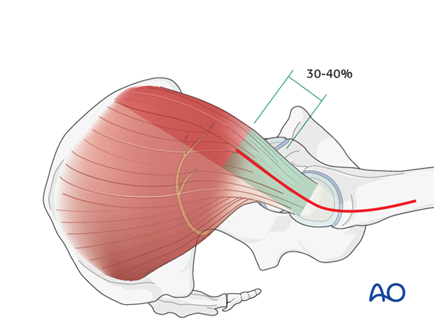 transgluteal approach