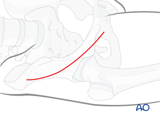 anterior approach