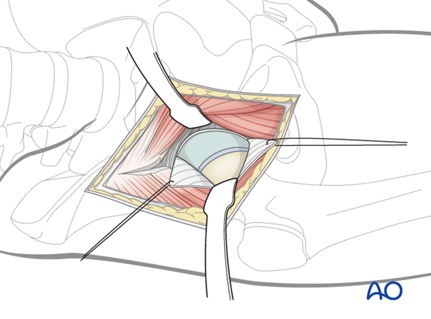 anterior approach