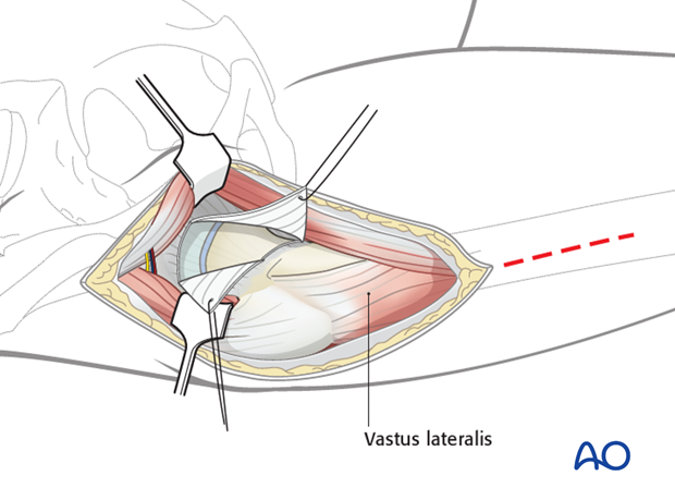 anterolateral approach