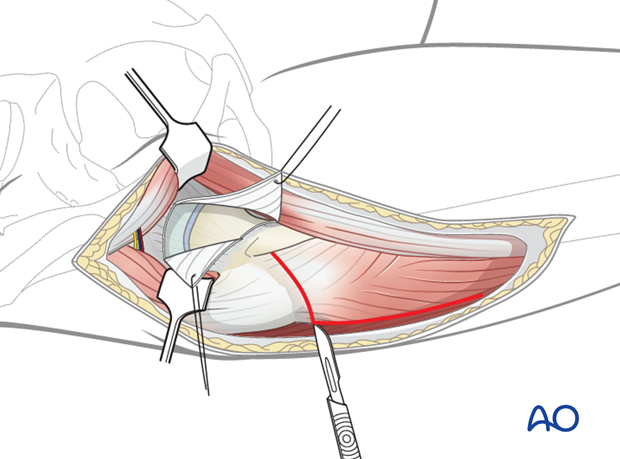 anterolateral approach