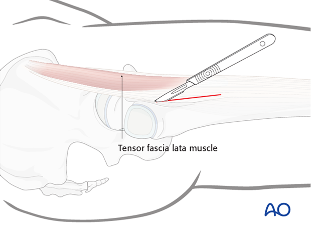 lateral approach