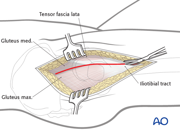 lateral approach via trochanteric flip