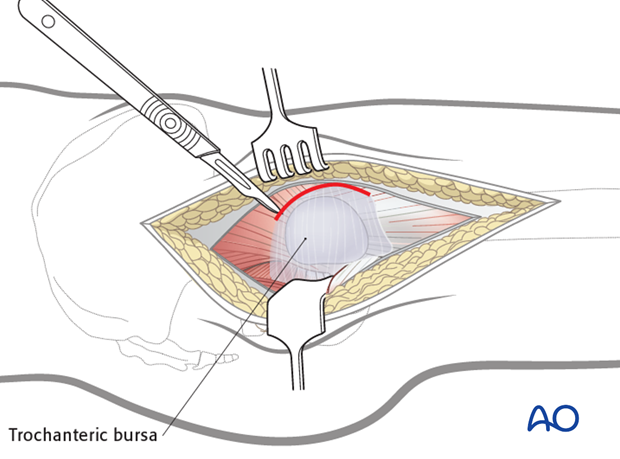 lateral approach via trochanteric flip