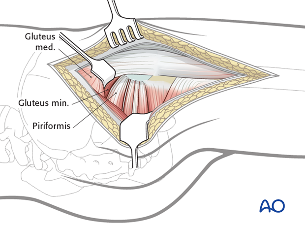 lateral approach via trochanteric flip