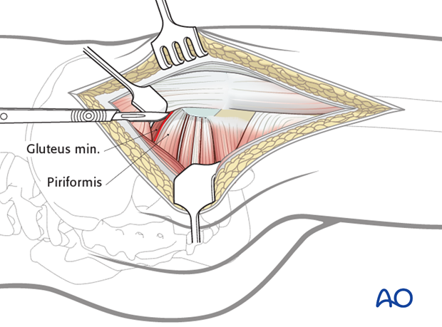 lateral approach via trochanteric flip