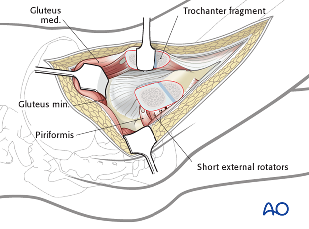 lateral approach via trochanteric flip