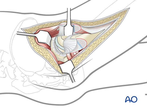 lateral approach via trochanteric flip