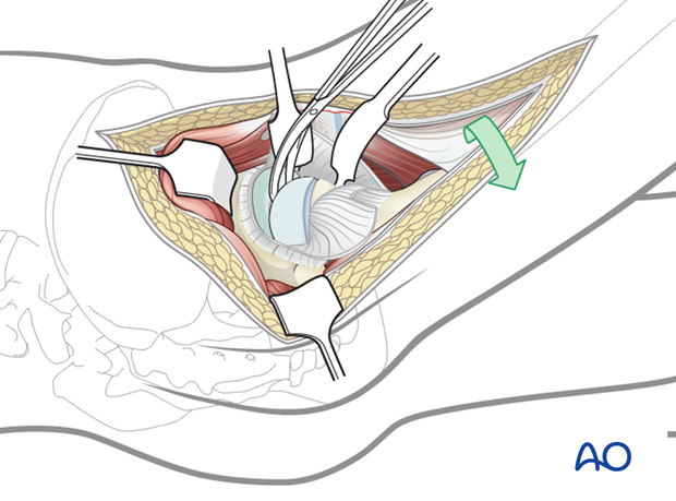 surgical hip dislocation