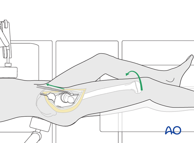 surgical hip dislocation