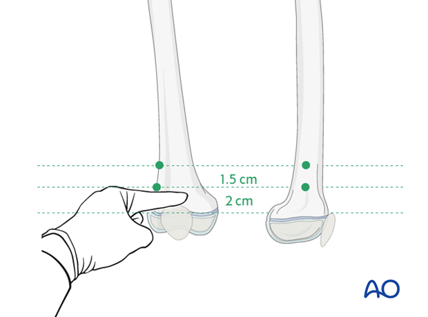 ESIN entry points for retrograde nailing