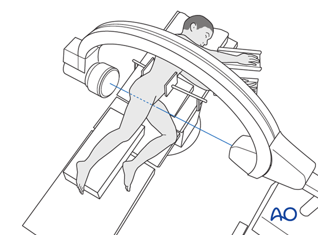 open reduction headless screw fixation