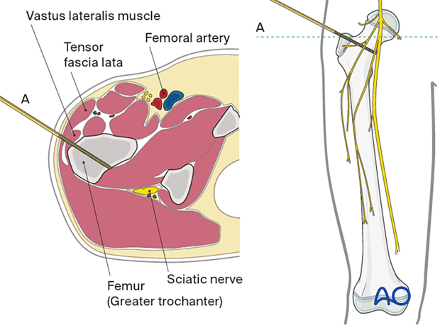 Safe pin placement through vastus lateralis and greater trochanter towards the lesser trochanter