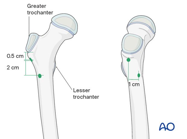 Position of nail entry points