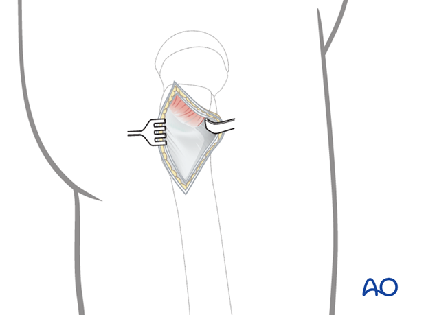 Exposure of the lateral cortex of the femur