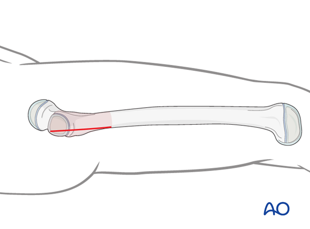 Proximal approach for plate insertion