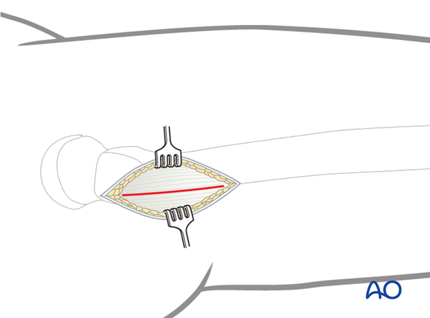 Incision of the fascia lata