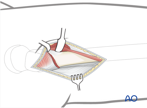 Elevation of vastus lateralis