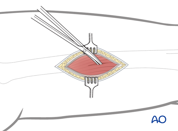 Small lateral incision without devascularization