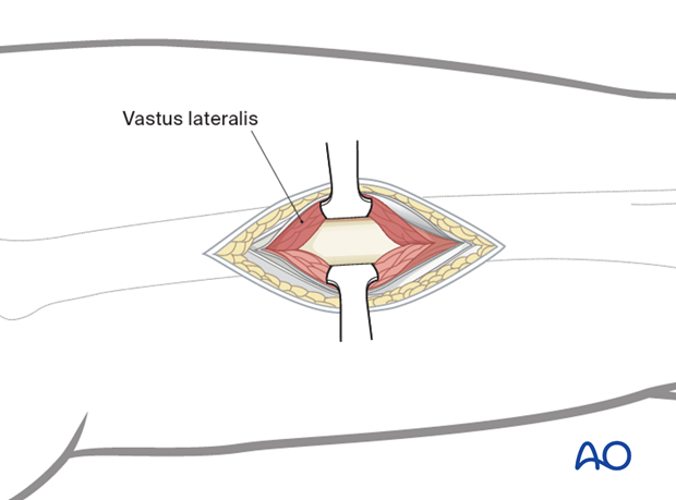 Exposure of the bone with Hohmann retractors