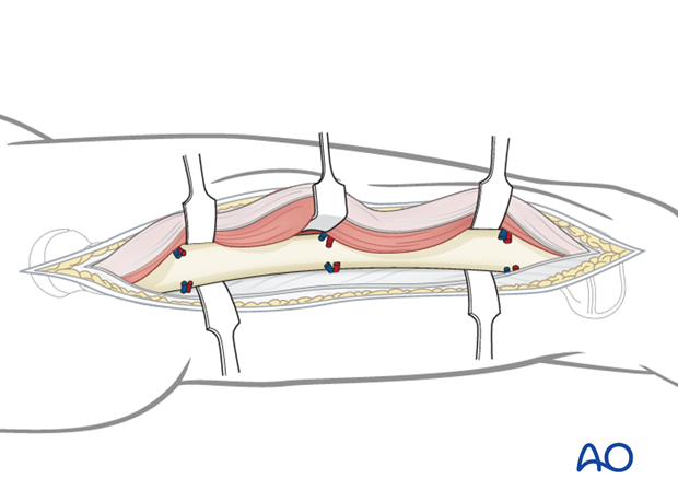 Exposure of the bone