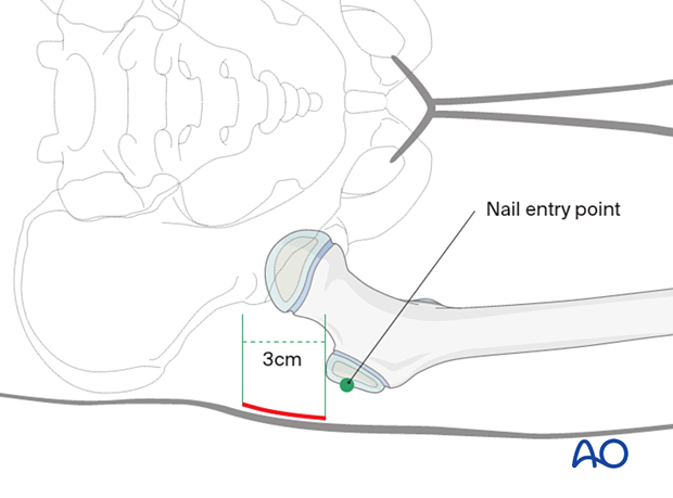 Skin incision for lateral entry point