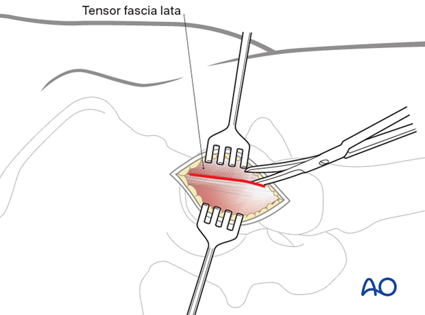 Deep dissection