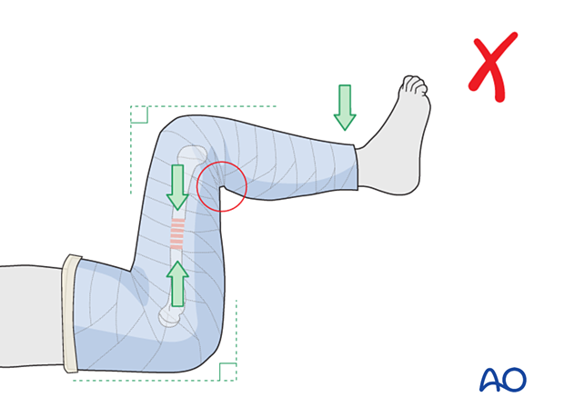 Avoiding flexion beyond 90°