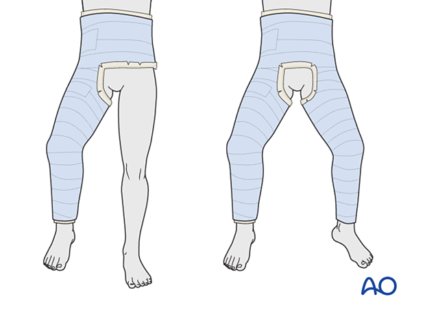 Single-leg and two-leg spica