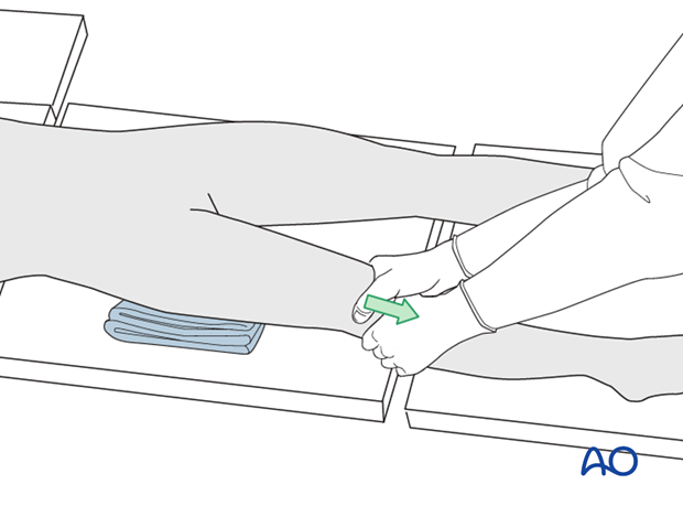 Manual traction for preliminary reduction