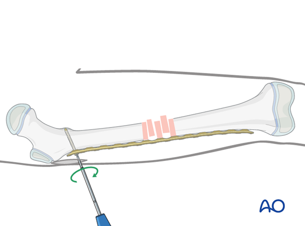 Insertion of the first screw