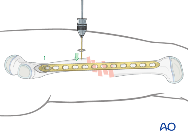 Aligning proximal fragment and plate with a Schanz screw 